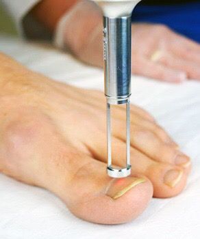 Ingrowing Toe Nail Removal - Primary Care Medicine - Irvine, CA - Advantage  Plus Medical Center